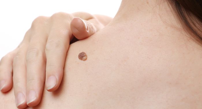 How much does it cost to get skin tags removed?