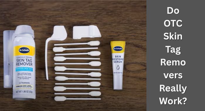 Do OTC Skin Tag Removers Really Work?