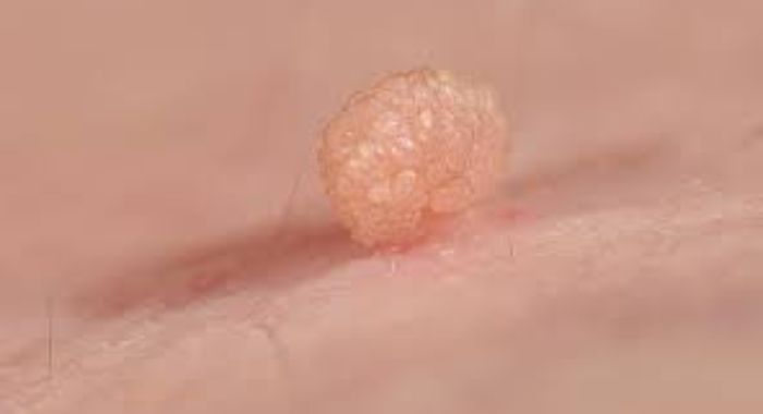 Tips for Finding Affordable Skin Tag Removal Near You