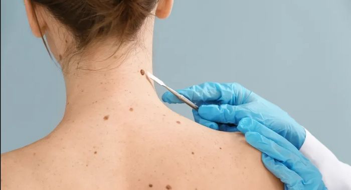 Skin Tag Removal Cost Factors to Know